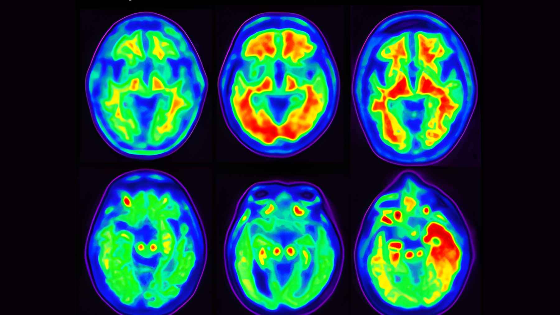 Microscopic view of neurons used in laboratory research studying tau protein buildup and brain aging.