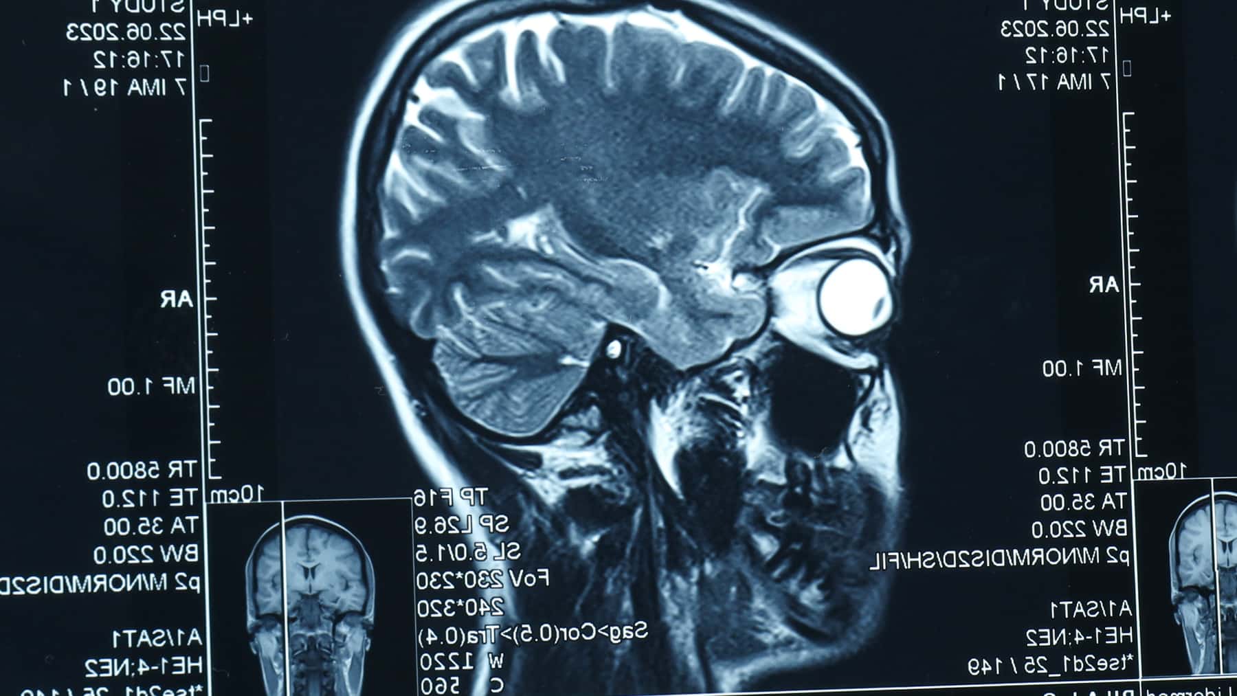 Los científicos coinciden: analizan el cerebro humano y descubren que su maduración estructural se prolonga hasta los 32 años
