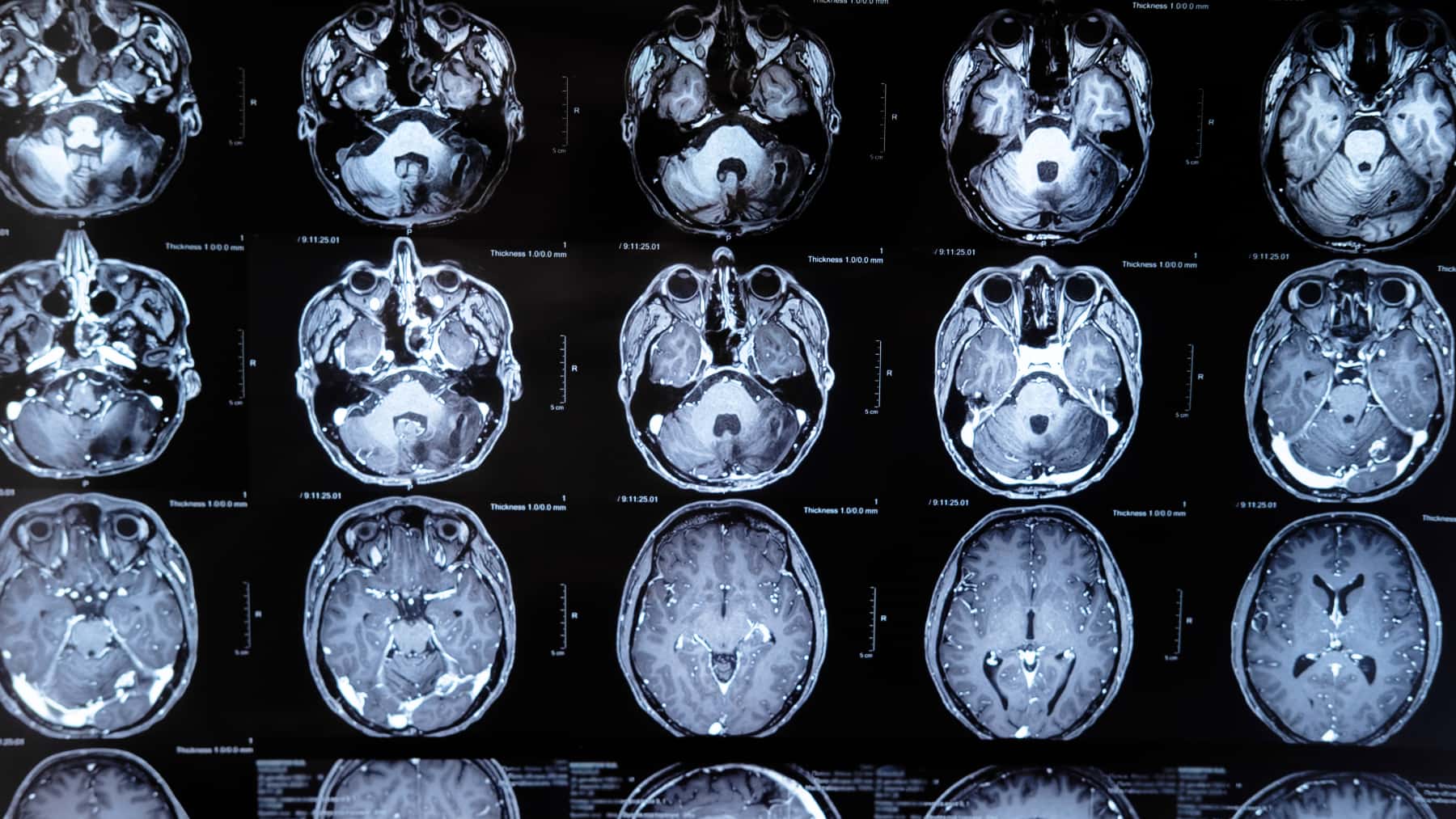 Imágenes de resonancia magnética cerebral mostradas en una pantalla durante una prueba médica neurológica.
